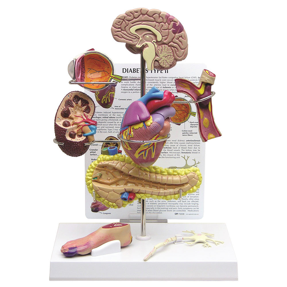 Type II Diabetes Set
