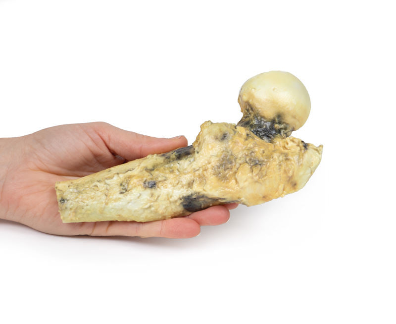 Osteosarcoma of femur