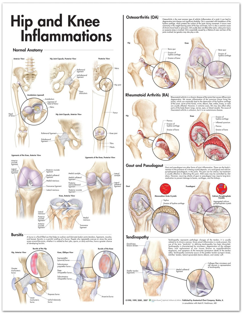 Hip and Knee Inflammation chart - 20" x 26"