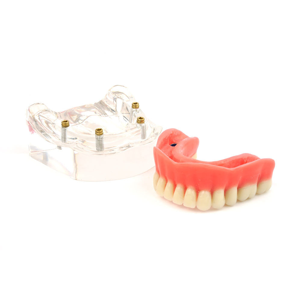 Overdenture model using 4 implant locators on an lower arch